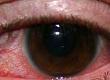 Herpes Infections in the Eye