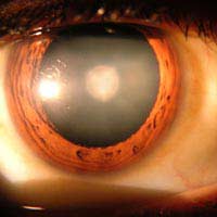 Cataract Operation Lens Dislocation