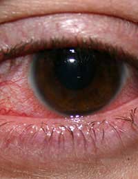 Herpes Infection Eye Infection Herpes