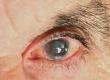 Causes of Blindness Worldwide: Facts and Figures