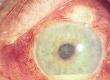 What Does Uveitis Mean?