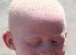 Eye Tests and Diagnosing Albinism