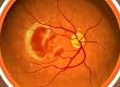 What is Age Related Macular Degeneration?