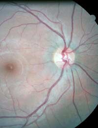 Retinitis Pigmentosa; Retina; Vision;