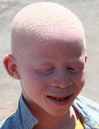 Albino Albinism Melanin Sun Damage