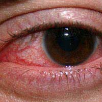 Keratitis Eye Infection Cornea Retina