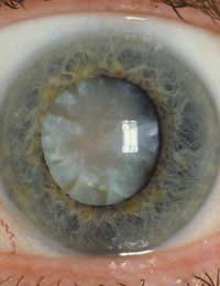 Patching lens Implant intraocular Lens