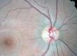 Retinitis Pigmentosa