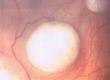 Benign Eye Tumours