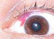 Is a Vitreous Haemorrhage Serious?