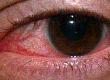 Symptoms and Causes of Keratitis