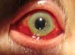 Rosacea in the Eye