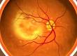 Treating Age Related Macular Degeneration