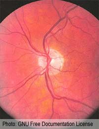 Retinal Vein Occlusion; Blockages;
