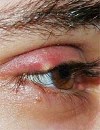 Stye; Gland; Eyelid; Sebaceous Gland;