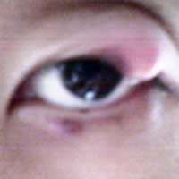 Chalazion; Lump; Eyelid; Irritation;