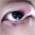 Chalazion or Lump on Eyelid