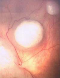 Eyes Eye Tumours Benign Growths Growths