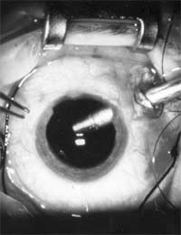 Vitrectomy Fluid Jelly Fluid Inside The