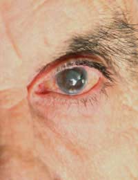 Sight Blind Visual Impairment Blindness