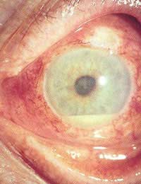 Uveitis Inflammation Of The Uvea Uvea