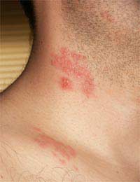 Shingles Herpes Zoster Chicken Pox Virus