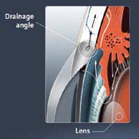 Glaucoma Chronic Glaucoma Acute Glaucoma