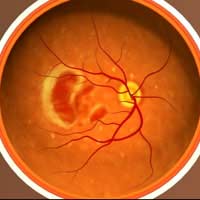 Macula Macular Degeneration Age Related