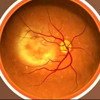 Anti-vegf Drugs photo Dynamic Therapy