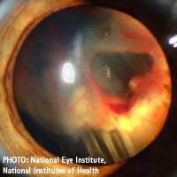 Detached Retina Retinal Detachment Cause