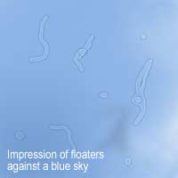 Flashes floaters retinal Detachment
